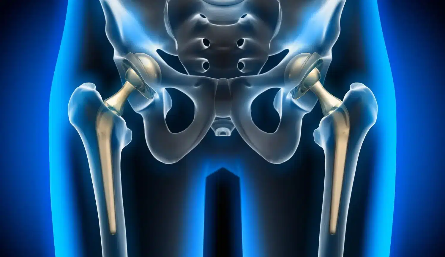 Total Hip Replacement: What to Expect Before, During, and After Surgery