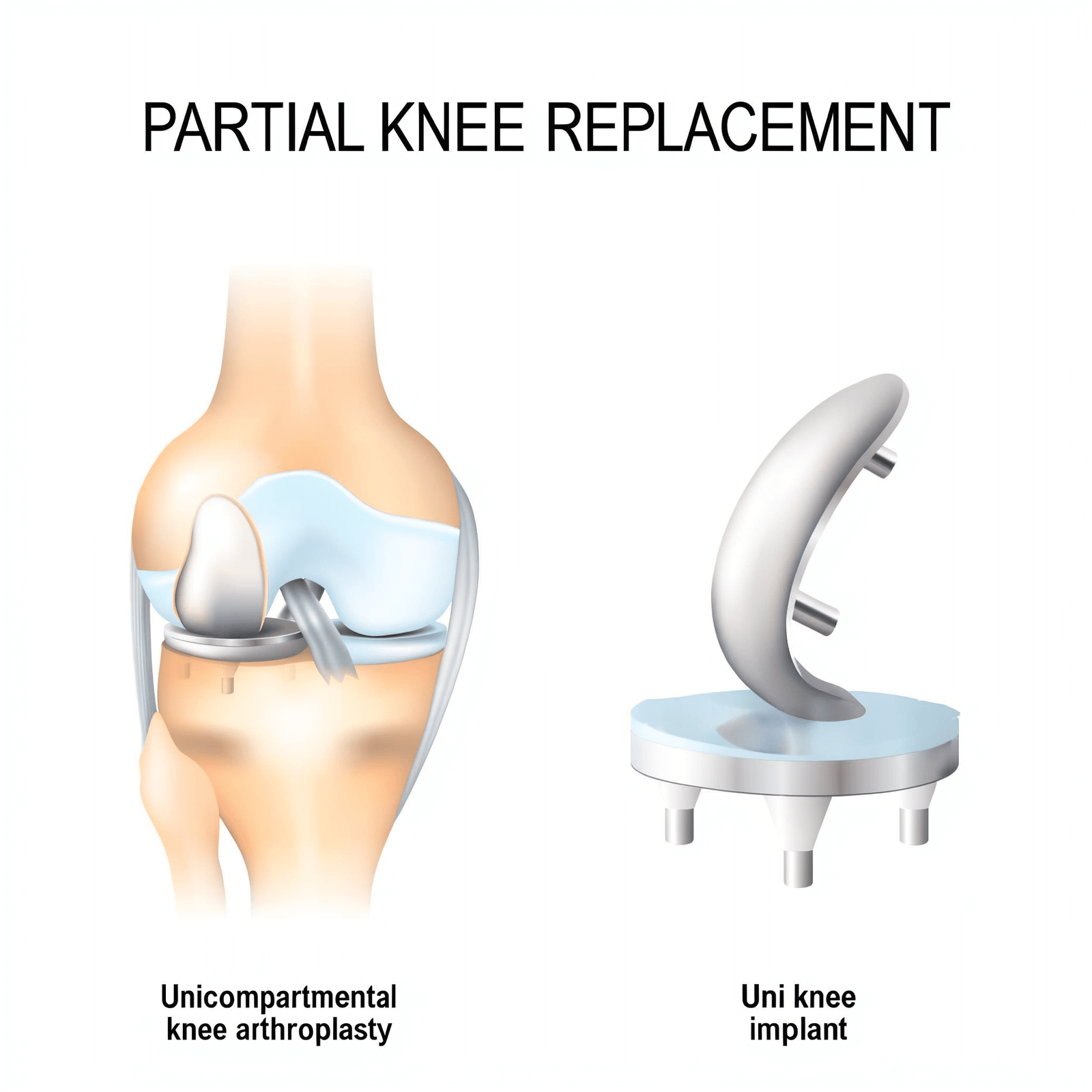 partial-knee-replacement (1)